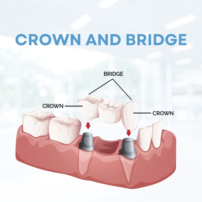 Crown and bridge